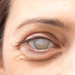 Glaucoma
