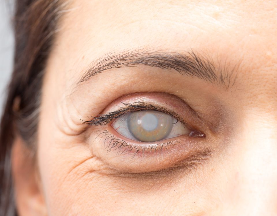 Glaucoma